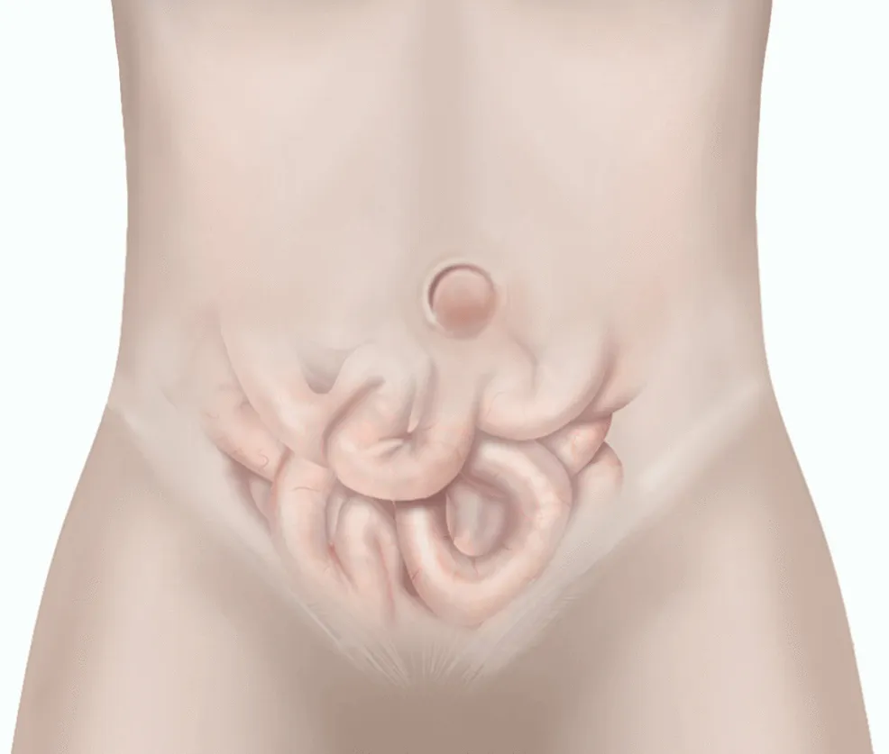 Buric ieșit în afară la bărbați. Ce afecțiuni grave poate însemna?