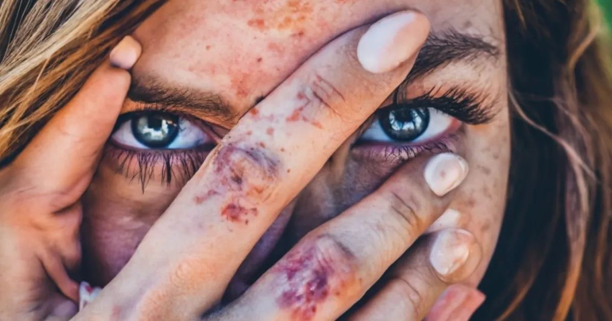 Cum să Îngrijești un Pacient cu Erizipel la Domiciliu