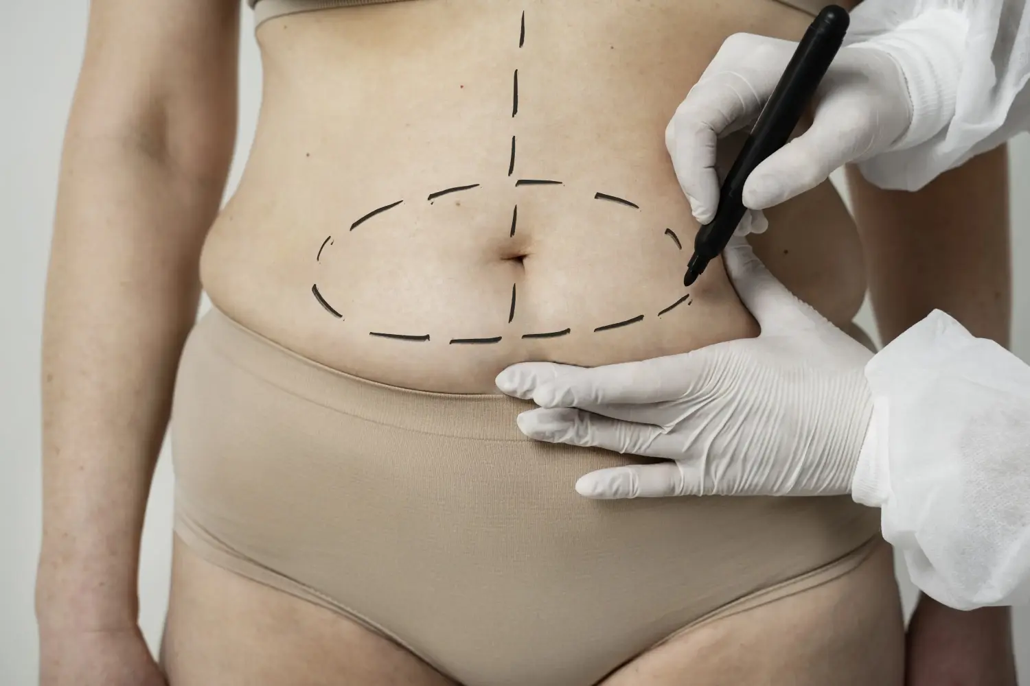 Abdominoplastie - Solutia pentru un abdomen ferm si tonifiat fara efort